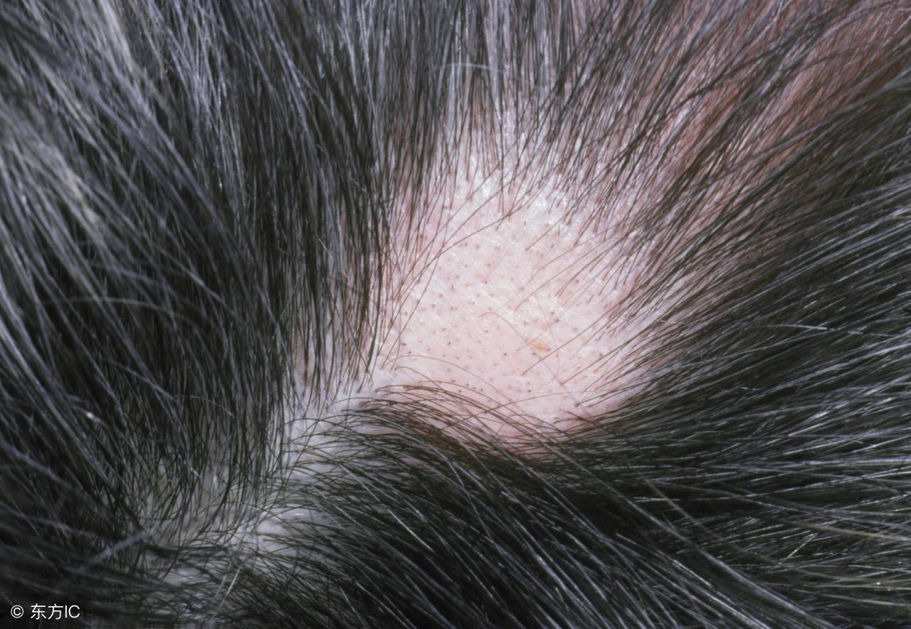 头发斑秃的原因,导致斑秃的罪魁祸首或是这6个