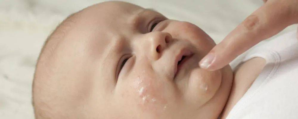 宝宝湿疹的症状,婴儿湿疹的症状与护理事项
