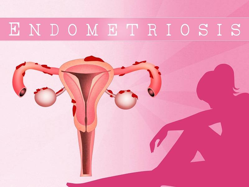 子宫内膜异位症的治疗,子宫内膜异位症有救了？