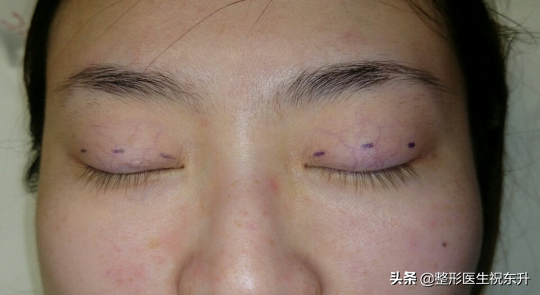 三点定位双眼皮手术,什么是三点式双眼皮？
