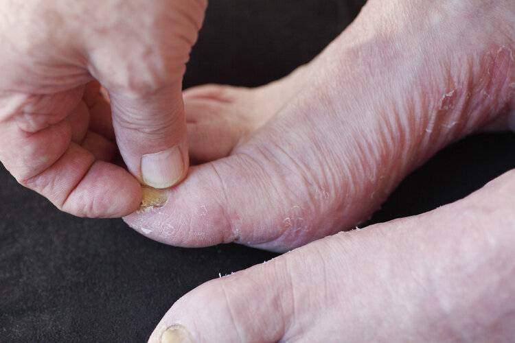 治疗灰指甲民间偏方,得了灰指甲怎么治？