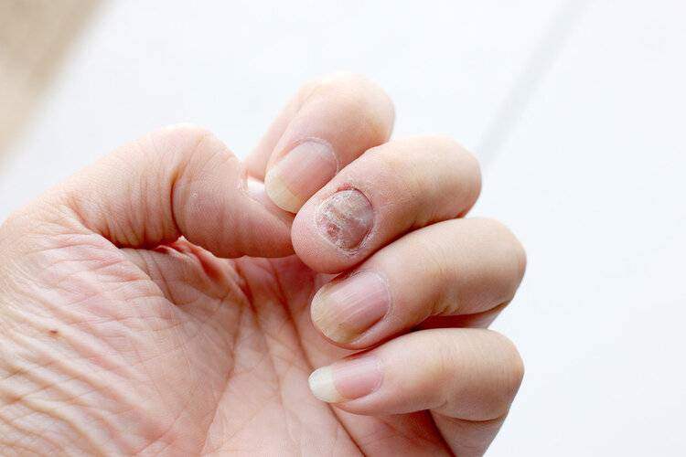 治疗灰指甲民间偏方,得了灰指甲怎么治？