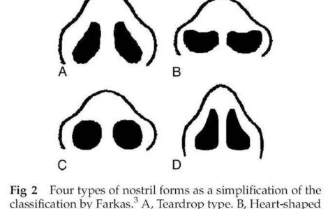 鼻孔大怎么办,鼻孔过大是因为哪些因素影响形成的？