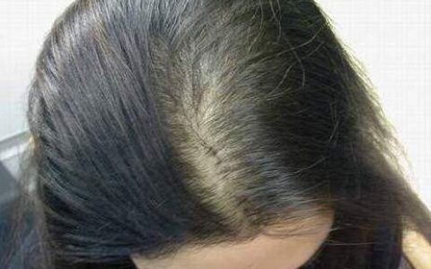 防止脱发的最好方法,预防脱发的10个秘诀！
